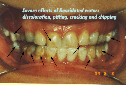 dental fluorosis bellingham